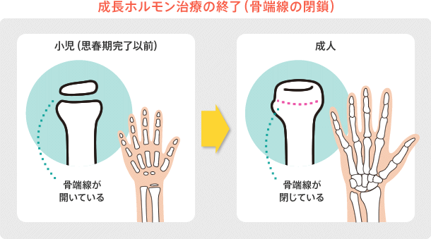 成長ホルモン治療の終了（骨端線の閉鎖）